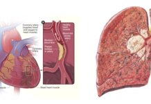 Existe-t-il un lien entre le cancer et les maladies cardiaques?
