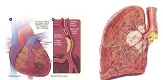 Existe-t-il un lien entre le cancer et les maladies cardiaques?