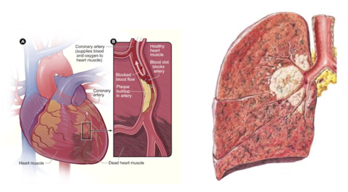 Existe-t-il un lien entre le cancer et les maladies cardiaques?